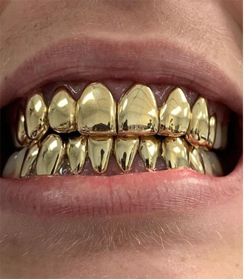 Gold teeth Gold teeth