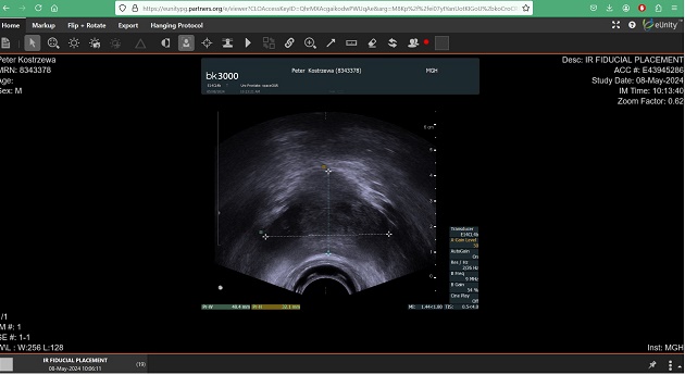 Fiducial placement Fiducial placement