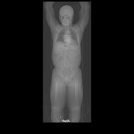PSMA PET scan PSMA PET scan