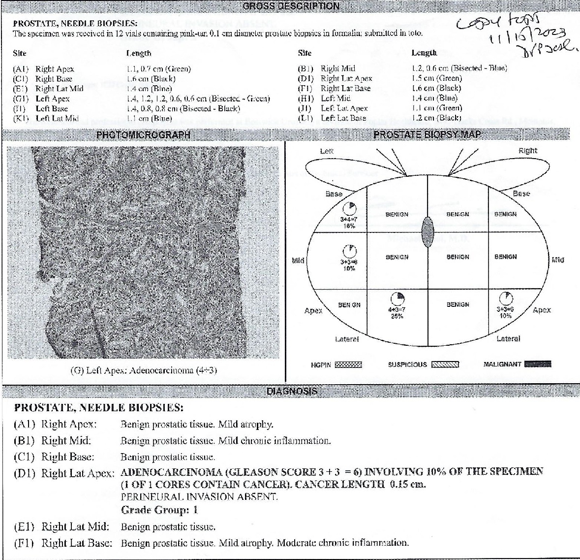 My biopsy report My biopsy report