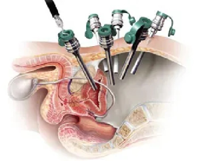 Robotic prostate surgery Robotic prostate surgery
